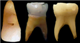 عکس دندان های شیری کودکان عصب و ریشه دندان های شیری