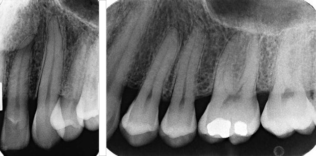 رادیوگرافی پری آپیکال Periapical یا تک دندان - عکس رادیولوژی دندان - رادیوگرافی دندان