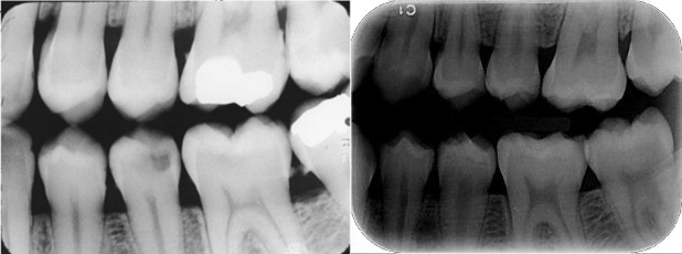 انواع عکس دندان - رادیوگرافی بایت وینگ Bitewing یا اینترپروگزیمال