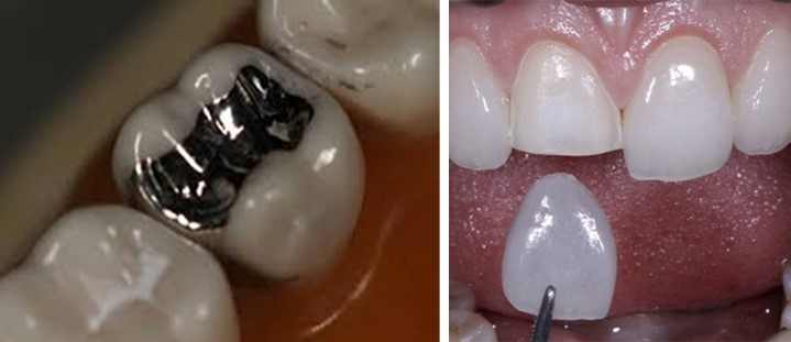  لمینت دندانی یک نمونه ترمیم آمالگام