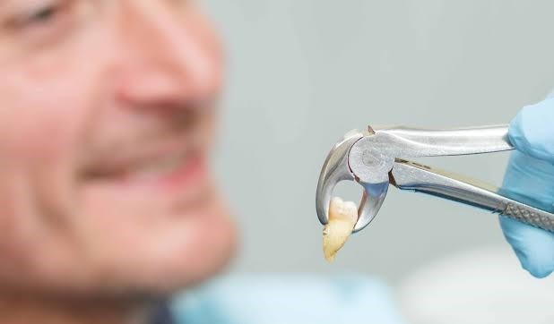 کشیدن دندان و دلایل آن - چرا دندان باید کشیده شود؟