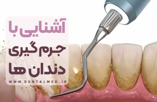 جرم گیری دندان (برساژ دندان ها) چیست همراه با فیلم آموزشی مراحل انجام - فواید و عوارض