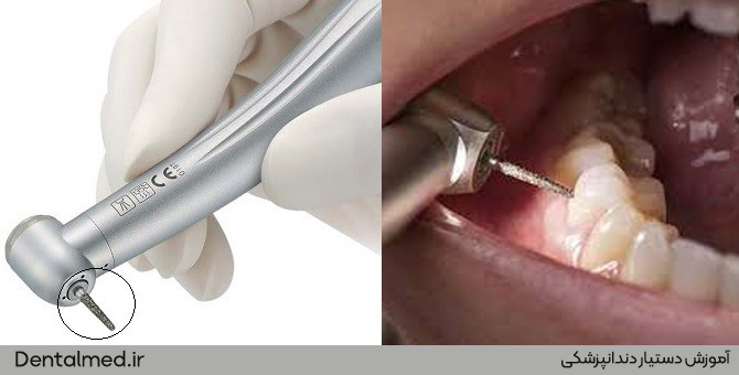  انواع فرز دندانپزشکی و کاربرد