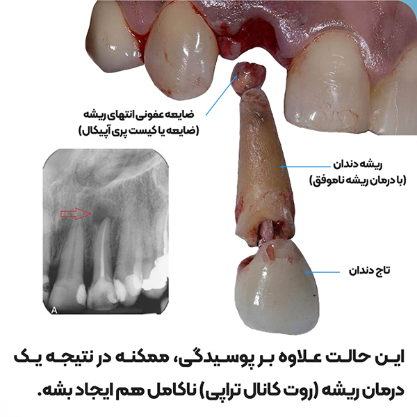 عکس کیست پری اپیکال Periapical cysts درمان کیست دندانی جراحی کیست دندان درمان کیست پری اپیکال