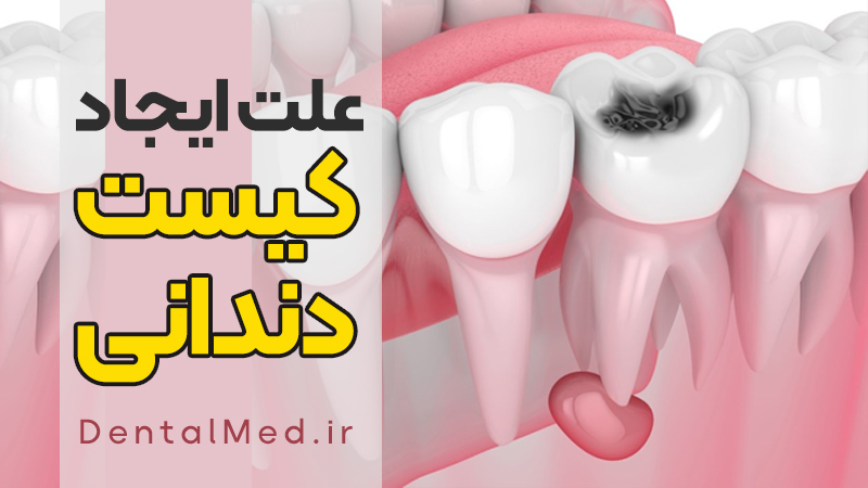 کیست دندان چیست ؟ کیست پری آپیکال درمان خانگی جراحی کیست و آبسه دندانی