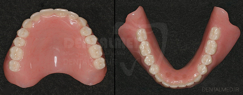 پروتز دندانی چیست , 1. پروتز کامل یا دنچر کامل متحرک Removable Complete (Full) Denture تصویر پروتز دندانی متحرک