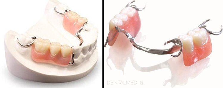 عکس پروتز پارسیل یا دنچر پارسیل متحرک Removable Partial Denture
