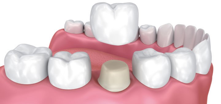 عکس روکش دندانی یا کراون Dental Crown 