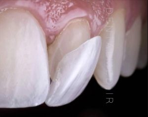 عکس لمینیت دندانی Dental Laminate