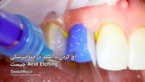 باندینگ Bonding در دندانپزشکی - اچینگ در دندانپزشکی - Acid Etching چیست آموزش دستیار دندانپزشکی مواد دندانپزشکی عکس مواد دندانپزشکی