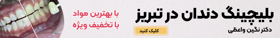 بلیچینگ دندان در تبریز