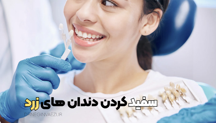 سفید کردن دندان ها زرد، بلیچینگ دندان در تبریز برای زردی دندان، ونیر کامپوزیتی در تبریز برای سفیدی دندان، لمینیت سرامیکی برای دندانپزشکی زیبایی در تبریز