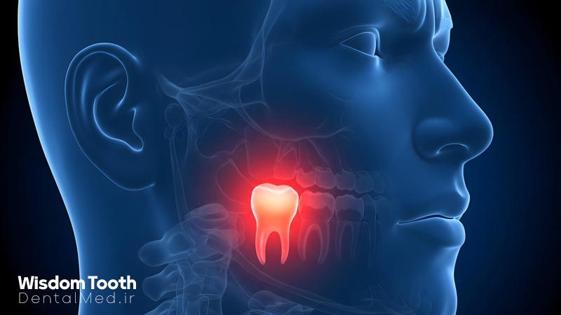 دندان عقل یا wisdom tooth چ یست زمان رویش و دندان عقل نهفته - هزینه جراحی دندان عقل در تبریز