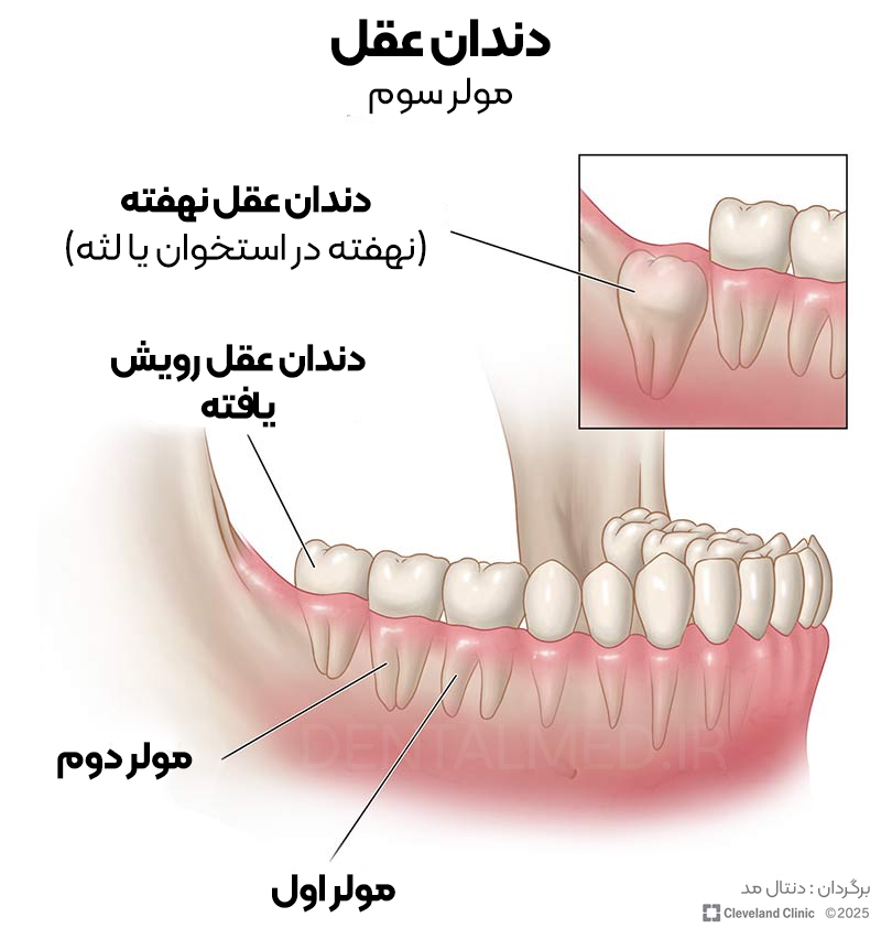 آناتومی دندان عقل و دندان عقل نهفته و جایگاه آن بر روی فک و زمان روش و نهفتگی آن