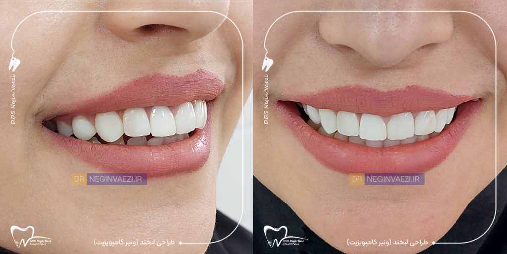 بهترین دکتر کامپوزیت تبریز و نمونه کار قبل و بعد از ونیر کامپوزیت دندان در تبریز