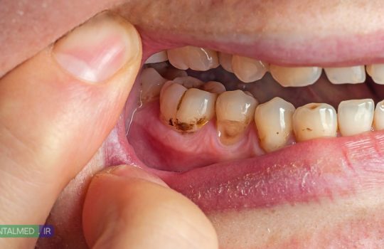 ۸ عامل مهم که خطر پوسیدگی دندان را افزایش می‌دهد