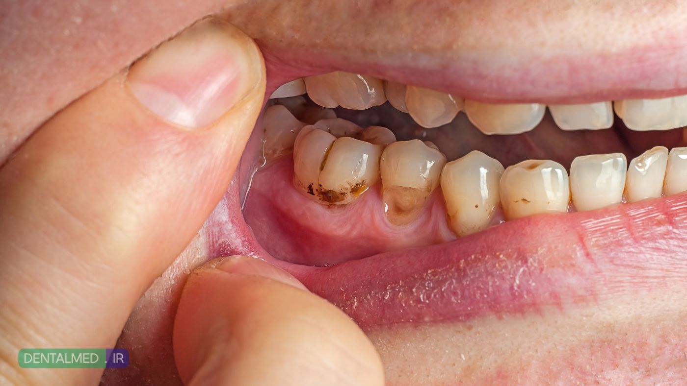 ۸ عامل مهم که خطر پوسیدگی دندان را افزایش می‌دهد