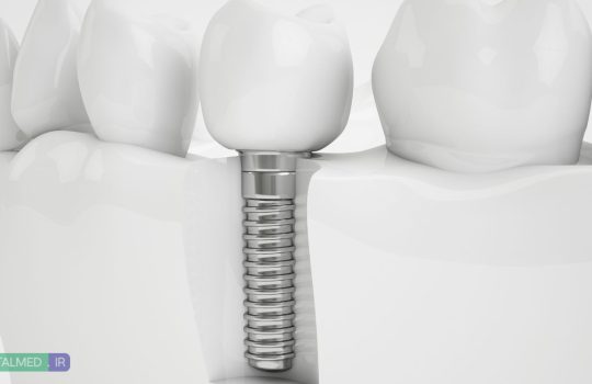 همه چیز درباره ایمپلنت دندان و کاشت آن - مقاله توسط دکتر نگین واعظی