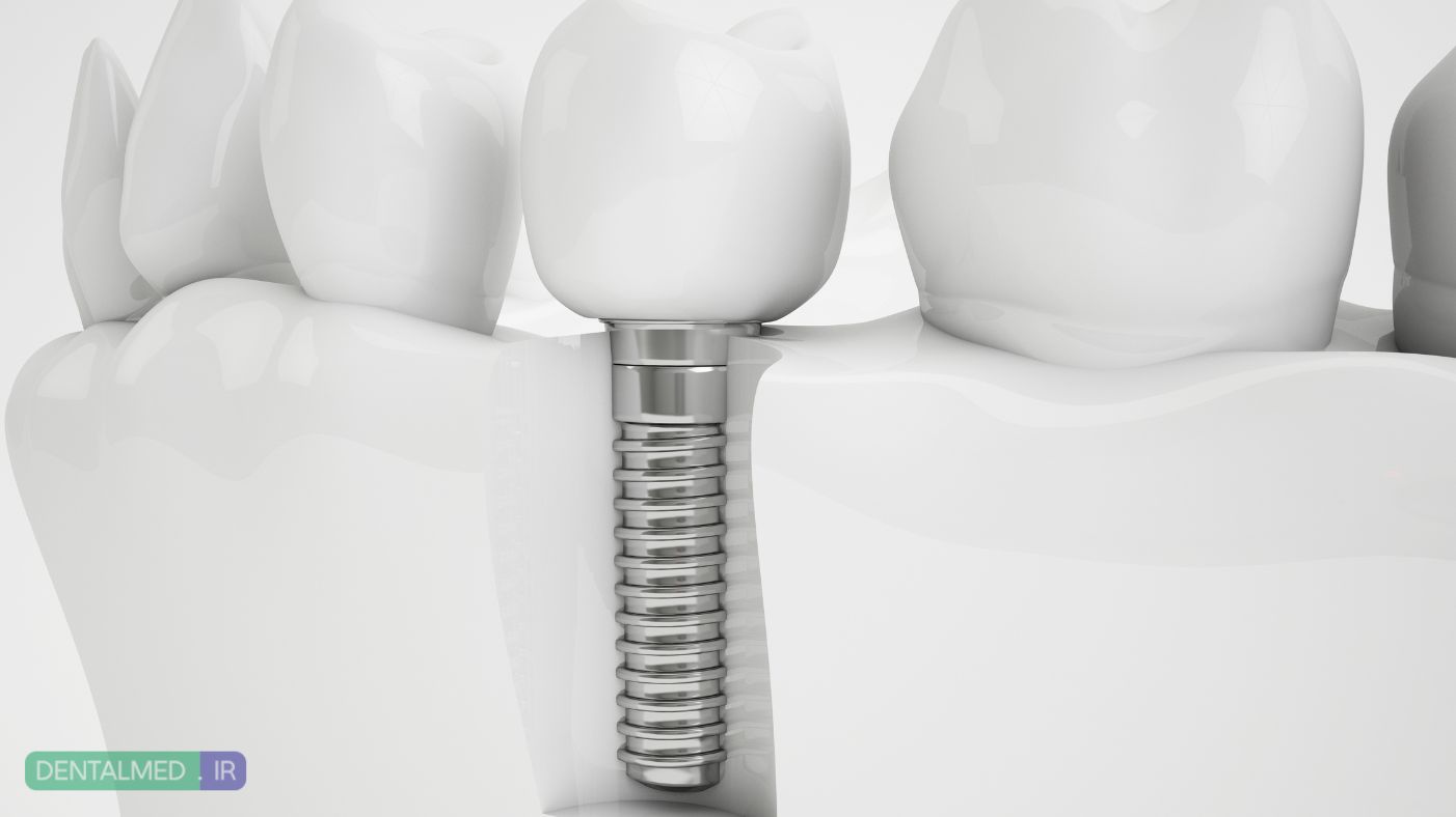 همه چیز درباره ایمپلنت دندان و کاشت آن - مقاله توسط دکتر نگین واعظی