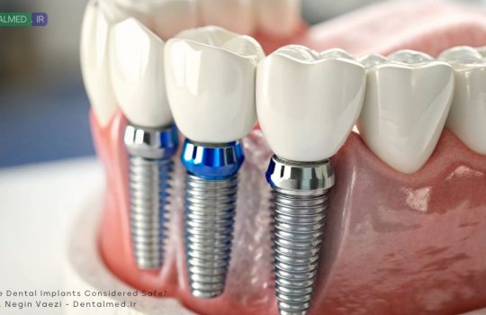 آیا ایمپلنت دندان خوب است؟ آیا ضرر دارد؟ آیا بی خطر است؟ ایمپلنت دندان خوب و با کیفیا
