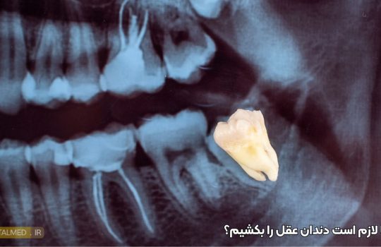 شیدن دندان عقل؛ چه زمانی لازم است و چه زمانی نه؟