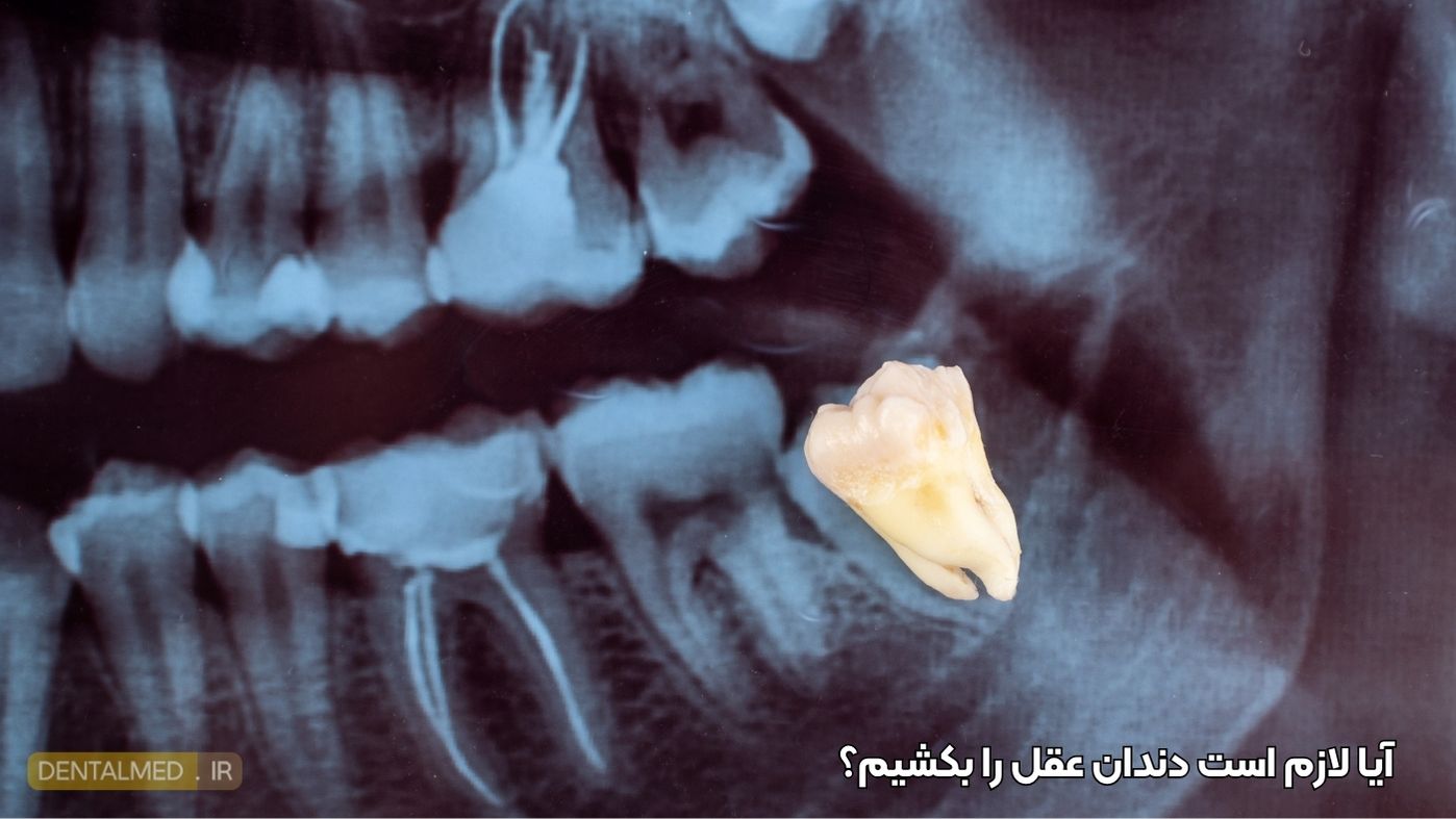 شیدن دندان عقل؛ چه زمانی لازم است و چه زمانی نه؟