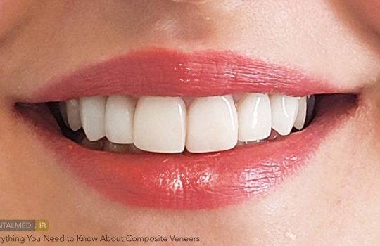 ونیر کامپوزیتی composite veneers چیست و تفاوت ان با ونیر سرامیکی و لمینت چه می باشد