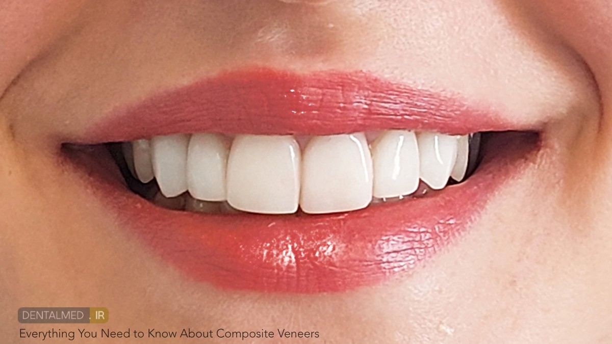 ونیر کامپوزیتی composite veneers چیست و تفاوت ان با ونیر سرامیکی و لمینت چه می باشد