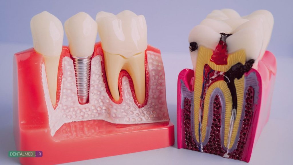 ایمپلنت بدون درد، هزینه ایمپلنت در تبریز، کاشت ایمپلنت دیجیتال، مزایای ایمپلنت، طول عمر ایمپلنت، عوارض ایمپلنت، مراقبت بعد از ایمپلنت