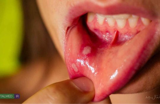آفت دهان چیست همه چیز درباره Mouth Ulcers و راه های درمان خانگی و پیشگیری و علت ها