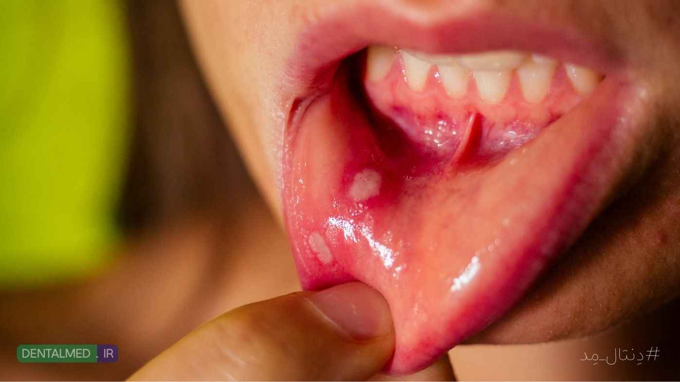 آفت دهان چیست همه چیز درباره Mouth Ulcers و راه های درمان خانگی و پیشگیری و علت ها
