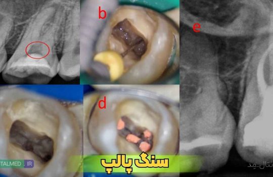 pulp stone,سنگ پالپ,پالپ استون,درمان سنگ پالپ,کلسیفیکاسیون پالپ