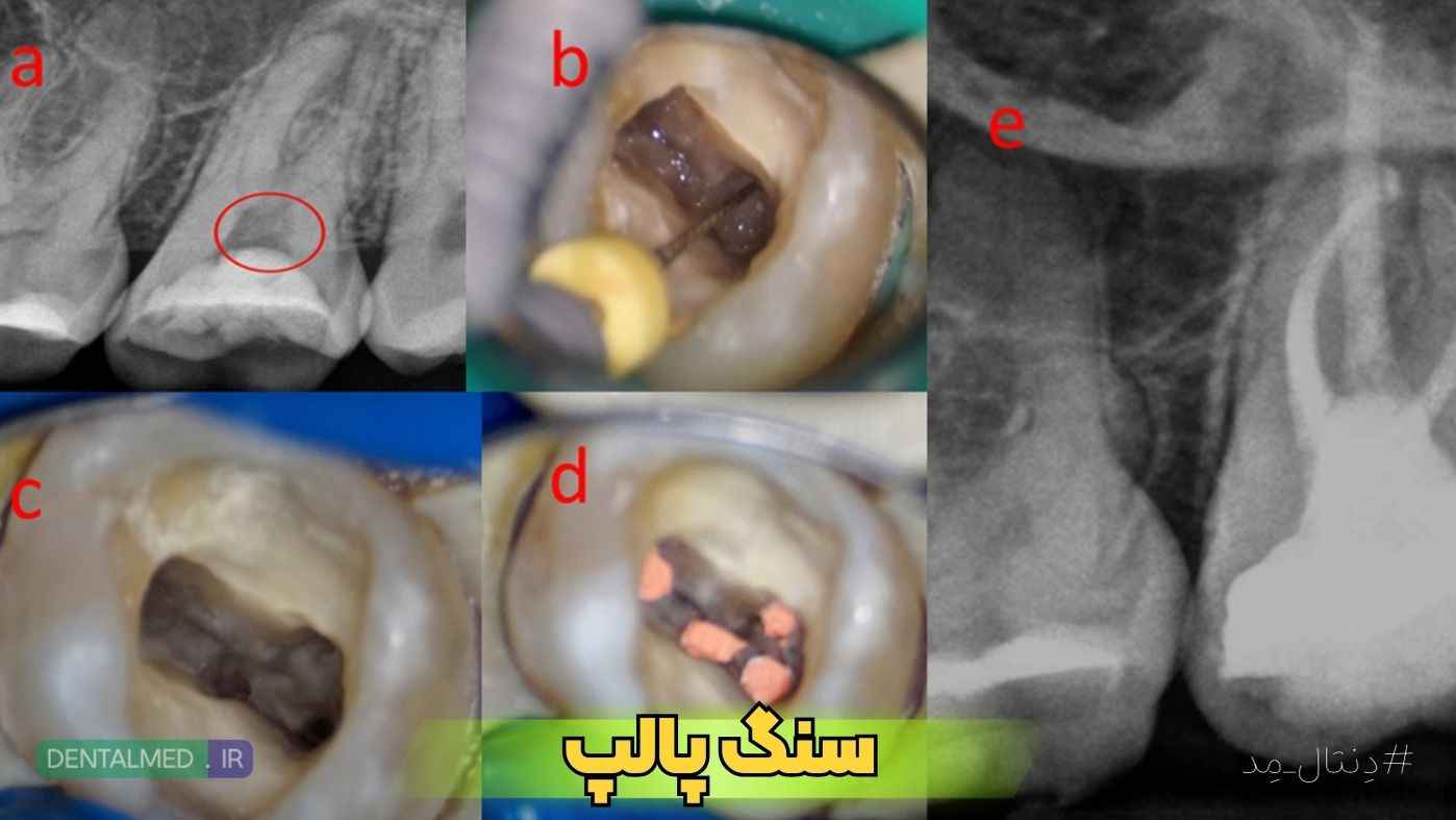 pulp stone,سنگ پالپ,پالپ استون,درمان سنگ پالپ,کلسیفیکاسیون پالپ