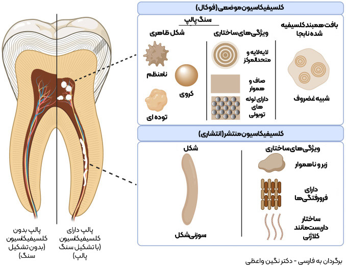 محل و ویژگی‌های مورفولوژیک کلسیفیکاسیون‌های موضعی و کلسیفیکاسیون‌های منتشر پالپ استون pulp stone