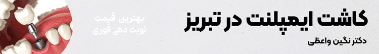 کاشت ایمپلنت در تبریز با بهترین قیمت و نوبت دهی فوری دکتر نگین واعظی
