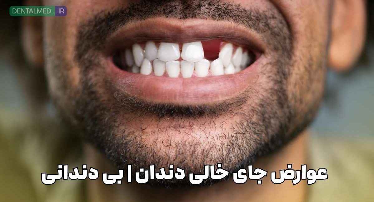 عوارض جای خالی دندان خطرات از دست دادن دندان درمان جای خالی دندان تحلیل استخوان فک بعد از کشیدن دندان بهترین روش جایگزینی دندان از دست رفته ایمپلنت برای دندان از دست رفته عواقب بی‌دندانی