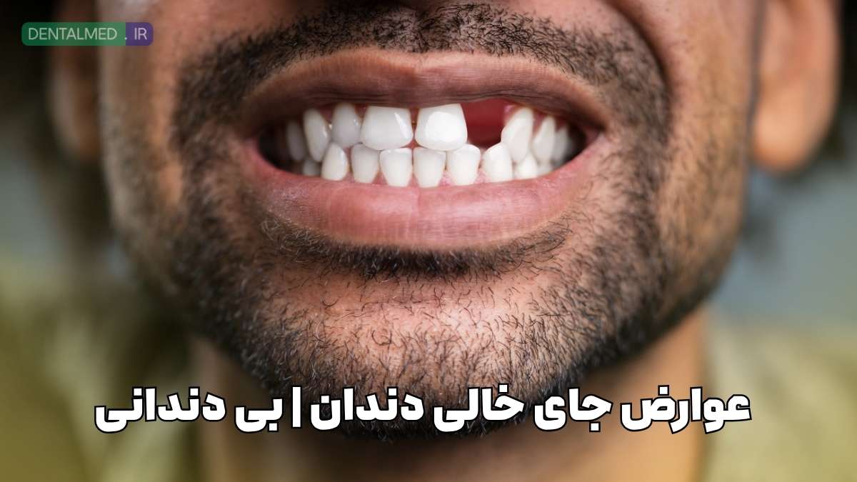 عوارض جای خالی دندان خطرات از دست دادن دندان درمان جای خالی دندان تحلیل استخوان فک بعد از کشیدن دندان بهترین روش جایگزینی دندان از دست رفته ایمپلنت برای دندان از دست رفته عواقب بی‌دندانی